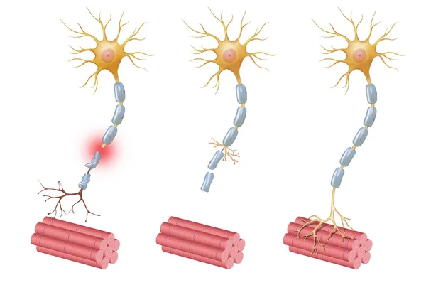 Neuroregenerazione Riferisce Alla Ricrescita Riparazione Tessuti Nervosi Cellule Prodotti Cellulari — Foto Stock