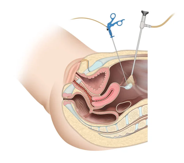 Fecondazione Mediante Estrazione Uova Laparoscopia Ginecologica — Foto Stock