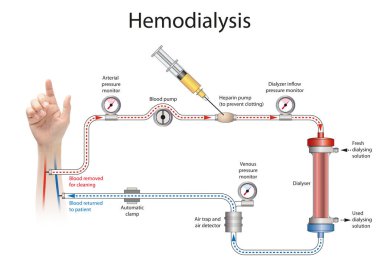 Hemodiyaliz ya da diyaliz böbrekleri normal çalışmayan bir insanın kanını arıtma sürecidir.