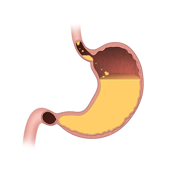 胃是一个肌肉 空心的器官 在消化系统中 胃在咀嚼后进入消化的第二阶段 — 图库照片
