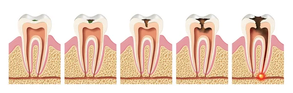 Etapas Del Desarrollo Caries Periodontitis — Foto de Stock