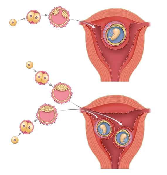 Zweieiige Und Eineiige Menschliche Zwillinge Embryo — Stockfoto