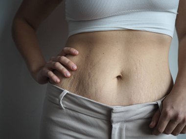 Kadın vücudu B pozitif, kendini beğenmiş, aşırı kilolu, çatlaklar var.