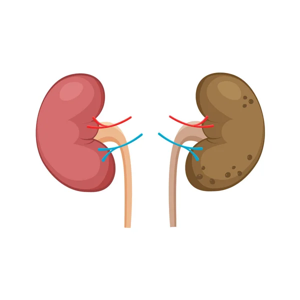 Riñones Poliquísticos Sanos Poco Saludables Enfermedad Renal Poliquística Icono Órganos — Vector de stock