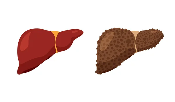 Yağlı Karaciğer Hastalığı Sağlıksız Karaciğer Sağlıklı Karaciğer Sindirim Sistemi Anatomisi — Stok Vektör