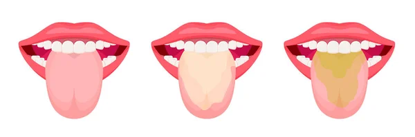 白いコーティングときれいな舌 口腔衛生 人間の体だ 白を基調としたベクトルイラスト — ストックベクタ