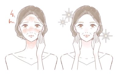 Orta yaşlı kadın yüz iltihabından muzdarip. Öncesinde ve sonrasında. Beyaz bir arkaplanda.