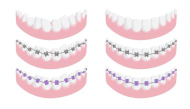 Sağlıklı diş ve diş teli izole edilmiş alt çene