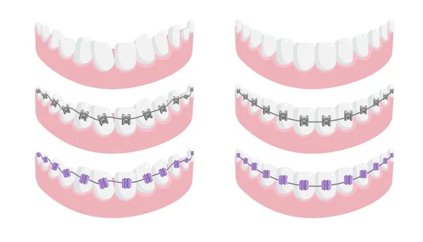 Mandíbula inferior com dente saudável e aparelho dentário conjunto isolado —  Vetores de Stock