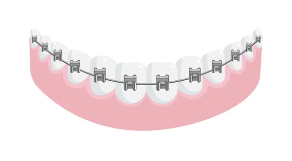 Metal aparelho dentário em dentes retos em goma de mandíbula —  Vetores de Stock