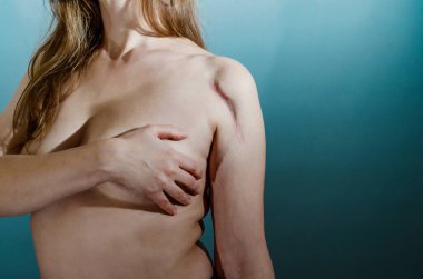 Kadın vücudu, ameliyattan sonra omuzunda koloid izi. Tıbbi konsept, kırık.