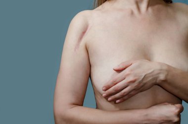 Kadın göğsünü koluyla kapatıyor, omuzunda yara izi var.