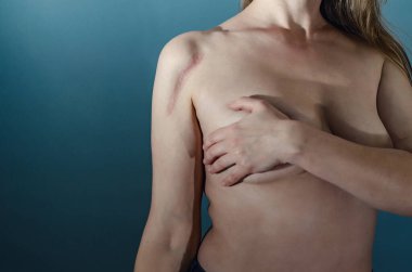 Ameliyattan sonra kadının omzunda koloidal yara izi var. Kemik üzerine metal plaka yerleştirilmiş. Yüksek kontrastlı, dramatik bir fotoğraf. Tıbbi illüstrasyon, kavram.