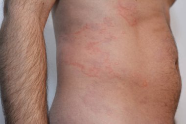 Şiddetli alerji nedeniyle bir adamın vücudunda deri döküntüleri olur..