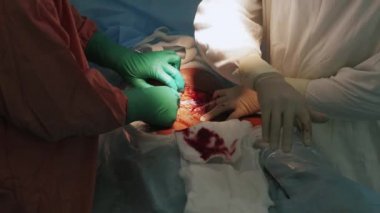 Cerrahlar kesi neşter tarafından hamile kadın karnına olun. Cesarean bölüm