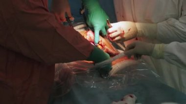 Cerrahların neşter tarafından hamile kadın mide kesti. Sezaryen operasyonu