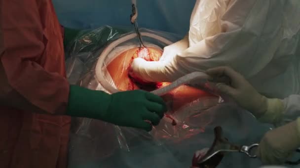 Cerrahlar hamile kadın mide yeni doğan çocuğu koy. Cesarean bölüm. — Stok video