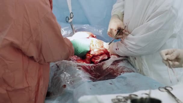 Хирурги зашивают живот женщины иголкой и ниткой. Кесарево сечение . — стоковое видео