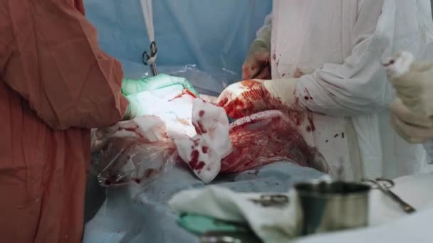 Surgeons sew up stomach of woman by needle and thread. Cesarean section. Surgery — Stock Video