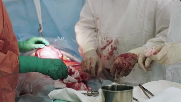 Cerrahlar kadar rahim, kadın iğne ve iplik tarafından mide dikmek. Cesarean bölüm. — Stok video