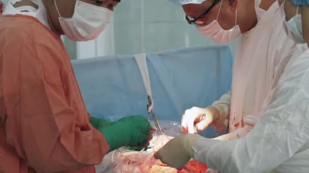 Cerrahlar yıkama içinde kadının, mide yarası dikin. Cesarean bölüm. İşlemi — Stok video