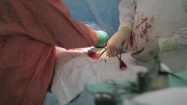 Cerrahlar kadar hastane içinde kadın mide dikmek. Cesarean bölüm. Hemşire. Kan