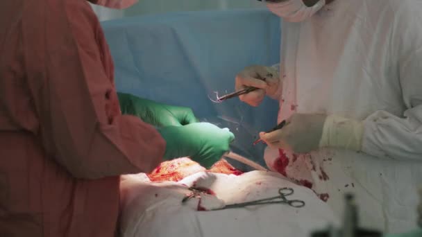 Los cirujanos cosen el vientre de la mujer por la aguja y el hilo. Cesárea. Equipos — Vídeo de stock