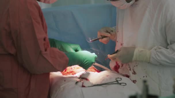 Cerrahlar, iğne ve iplik tarafından kadın mide dikmek. Cesarean bölüm. Ekipman — Stok video