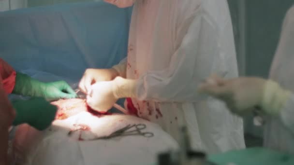 Хирурги зашивают живот женщины иголкой и ниткой. Кесарево сечение. Медсестра — стоковое видео
