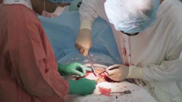 Cerrahlar kadın mide kadar iğne ve iplik dikiş. Cesarean bölüm. Kan. — Stok video