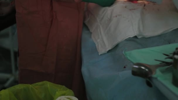 外科医生缝合胃的女人由线程。剖宫产。手术室. — 图库视频影像