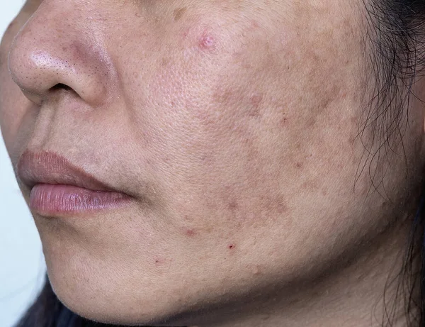 Close up of Asian adult woman face has freckles, large pores, blackhead pimple and scars problem from not take care for a long time. Soft focus of skin problem face. Treatment and Skincare concept