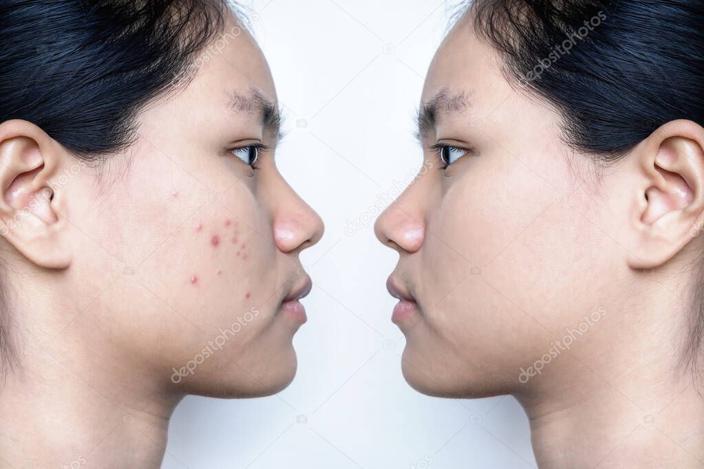 Young Asian woman face before and after acne treatment on white background. Skincare concept.