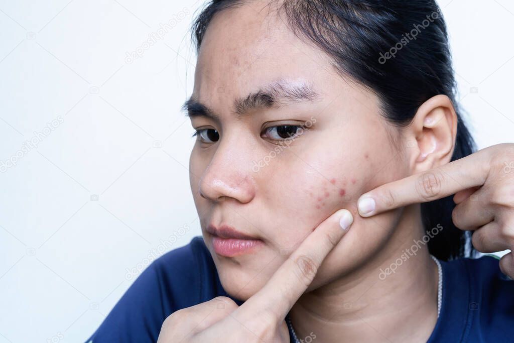Portrait of a worried young Asian woman squeezing her acne with white background. Skin problem of pimple, selective focus on front eyes. Teenager squeezing her face by fingers. Skincare concept.