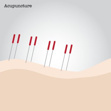 Akupunktur tedavi görüyor.