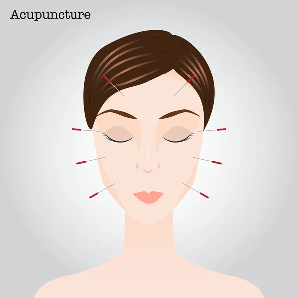 Mujer recibiendo un tratamiento de acupuntura — Vector de stock