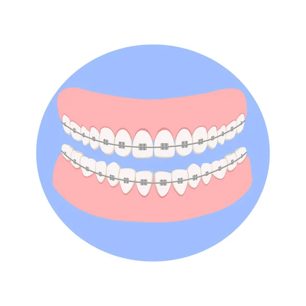 Mandíbula Dentária Com Dentes Brancos Com Aparelho Fundo Azul Mordida — Vetor de Stock