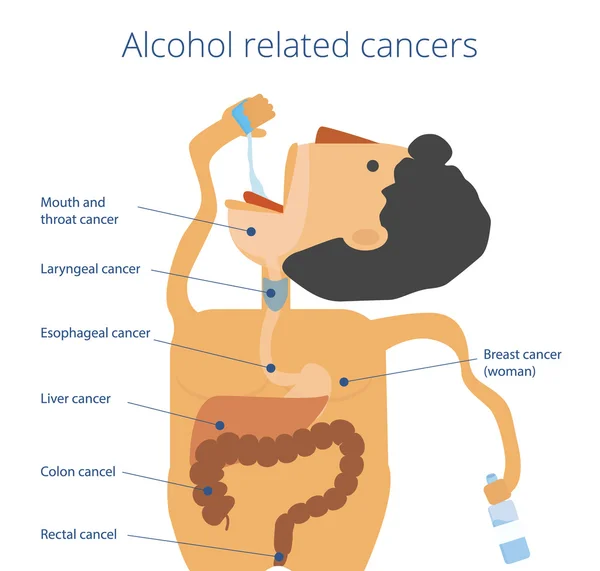 El alcohol causa siete cánceres ilustración . — Vector de stock