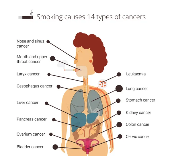 Infográfico sobre cânceres relacionados ao tabagismo —  Vetores de Stock