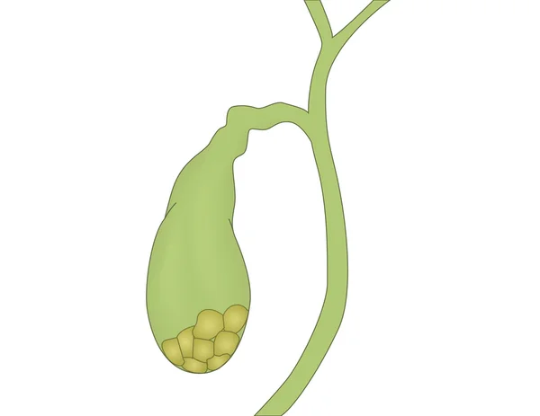 Gall stone vector illustration.Isolated vesícula biliar con piedras — Archivo Imágenes Vectoriales