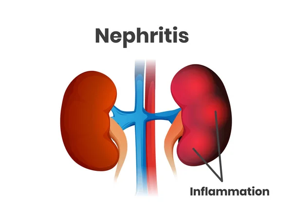 Illustration Atteinte Rénale Aiguë Illustration Santé Inflammation Des Reins — Image vectorielle