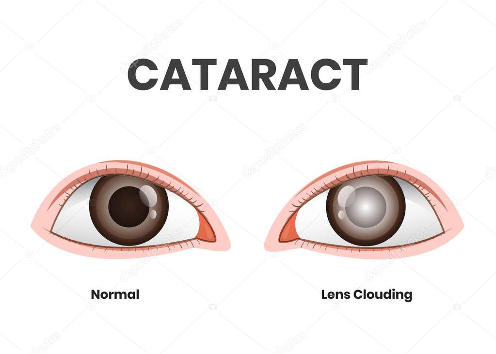 Eye disease illustration. Healthy eye versus lens clouding