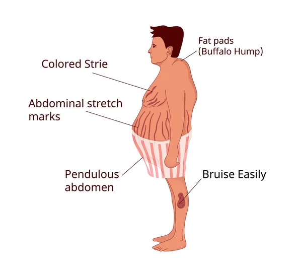 Anzeichen Und Symptome Des Cushing Syndroms Illustration Des Übergewichtigen Mannes — Stockfoto