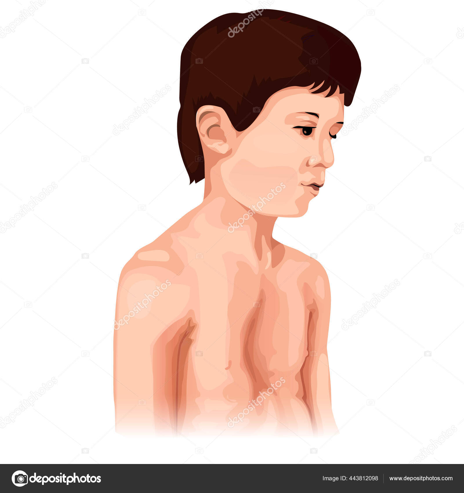 Chest Deformation Disorder Type Sad Boy Pectus Excavatum Marfan Syndrome Stock Vector Image By C Kavusta 443812098