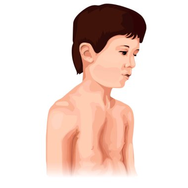Chest deformation disorder type. A sad boy with pectus excavatum. Marfan syndrome sign and symptoms clipart