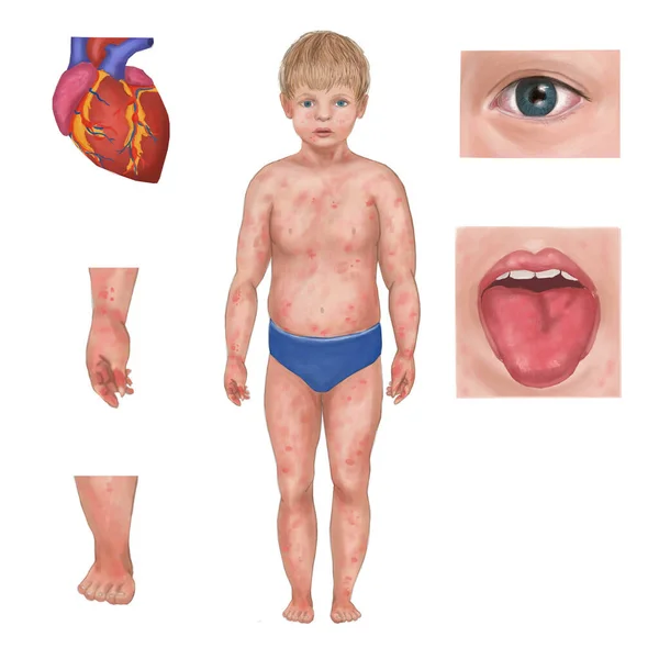 川崎病症状 川崎血管炎の一般的な兆候 結膜炎 動脈動脈瘤に苦しむ少年のイラスト — ストック写真