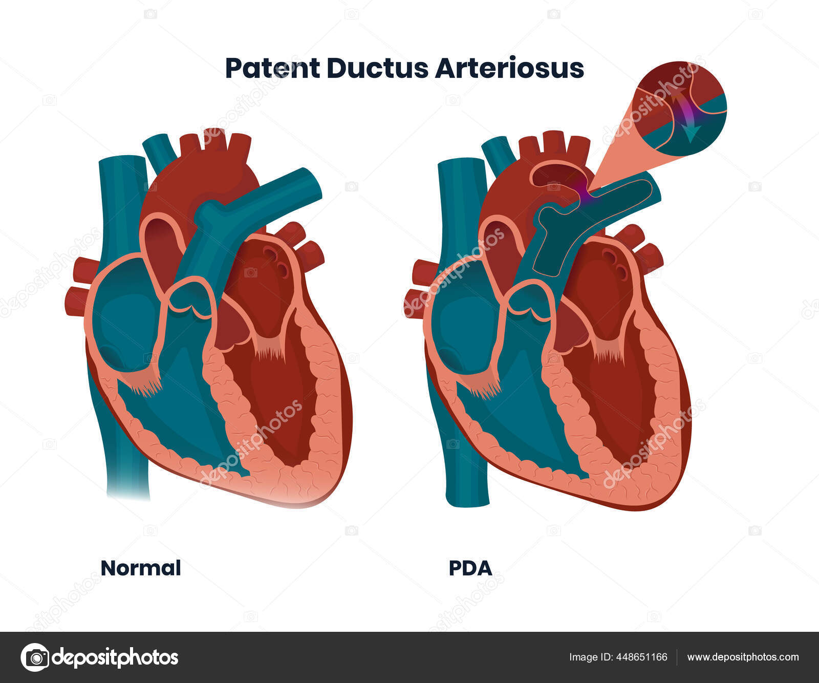 Conducto Arterioso Permeable Con Anatom a Cardiaca Normal Ilustraci n conducto-arterioso-permeable-con-anatom-a-cardiaca-normal-ilustraci-n