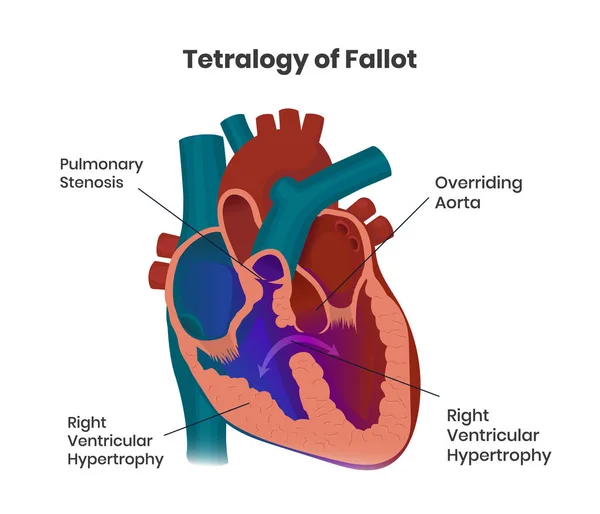 Tetralogy Fallot Composition Heart Defects Congenital Heart Defect Anatomy Vector — Stock Vector