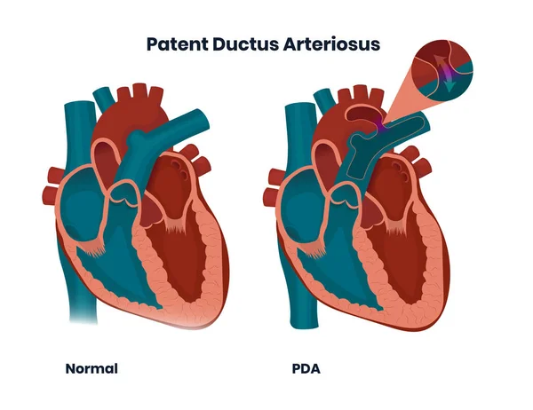 Ductus Arteriosus Mit Normaler Herzanatomie Patentieren Vektorillustration Der Angeborenen Herzanomalie — Stockvektor