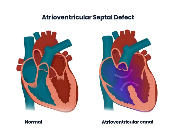 Defecto Septal Auriculoventricular Ilustración Cardiopatía Congénita Pared Que Separa Aurículas — Archivo Imágenes Vectoriales